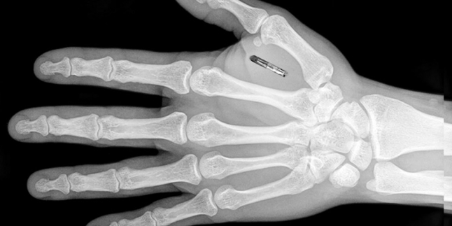 Chip 'Jempol', Pengganti Kartu ATM